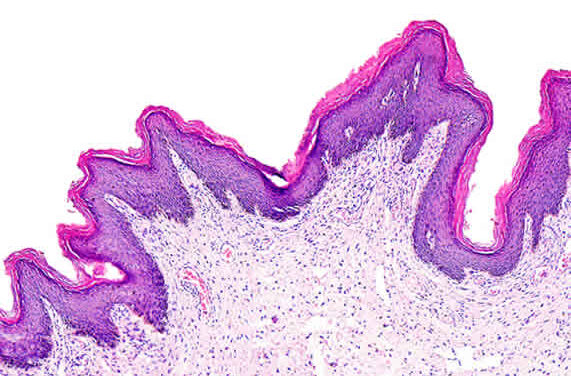 Papillomavirus: Stato Attuale e Prospettive di Prevenzione dei Tumori da HPV